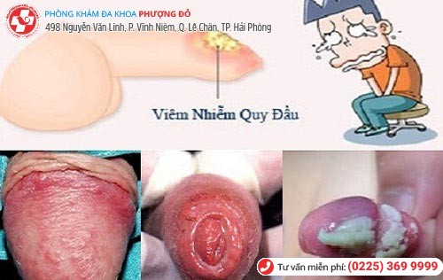 Hình ảnh dương vật có cặn trắng do viêm bao quy đầu Hình ảnh dương vật có cặn trắng do viêm bao quy đầu