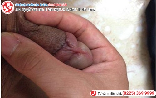 mọng nước dương vật