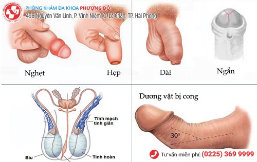 Chỉnh hình dương vật 