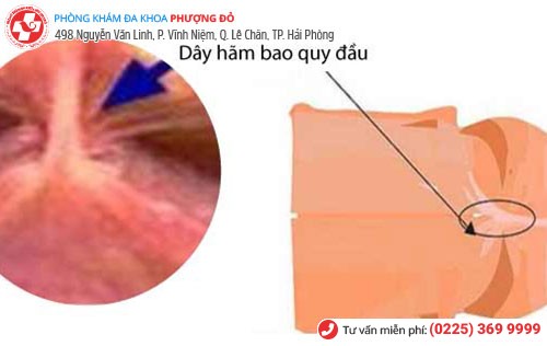 Hình ảnh dây hãm bao quy đầu