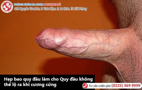 Hẹp bao quy đầu là gì? Cách chữa hẹp bao quy đầu hiệu quả Hẹp bao quy đầu là gì? Cách chữa hẹp bao quy đầu hiệu quả