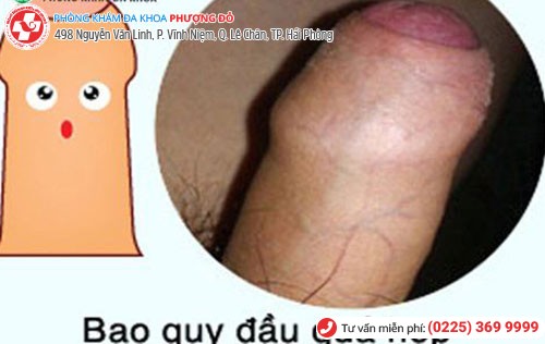 Dấu hiệu hẹp bao quy đầu Dấu hiệu hẹp bao quy đầu