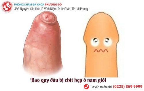 Bao quy đầu không tụ tuột được do hẹp bao quy đầu Bao quy đầu không tụ tuột được do hẹp bao quy đầu