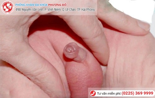 Hẹp bao quy đầu là gì? Cách chữa hẹp bao quy đầu hiệu quả Hẹp bao quy đầu là gì? Cách chữa hẹp bao quy đầu hiệu quả