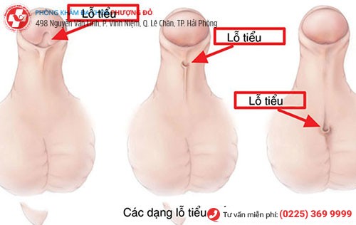 Hẹp lỗ tiểu do bẩm sinh Hẹp lỗ tiểu do bẩm sinh