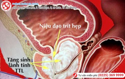 hẹp niệu đạo