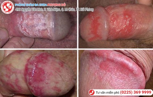 Mẩn đỏ bao quy đầu ở nam giới Hình ảnh mẩn đỏ bao quy đầu