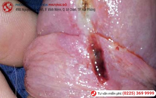 Hình ảnh rách bao quy đầu Hình ảnh rách bao quy đầu