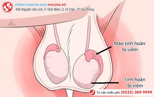Hình ảnh viêm tinh hoàn Hình ảnh viêm tinh hoàn