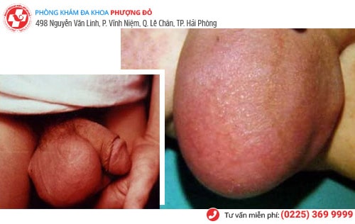 thuốc chữa viêm tinh hoàn