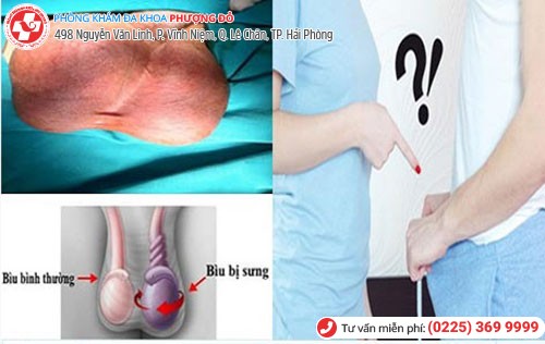 Hình ảnh tinh hoàn bị xoắn Hình ảnh tinh hoàn bị xoắn