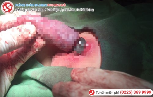 hoại tử dương vật