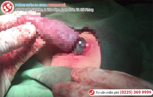 hoại tử dương vật