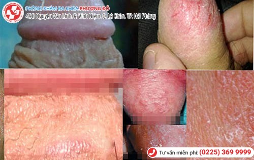 Hình ảnh da bao quy đầu bị khô Hình ảnh da bao quy đầu bị khô