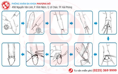 Quy trình cắt bao quy đầu bằng kỹ thuật xâm lấn tối thiểu công nghệ Hàn Quốc Kỹ thuật xâm lấn tối thiểu cắt bao quy đầu