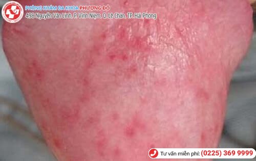 mẫn đỏ đầu dương vật