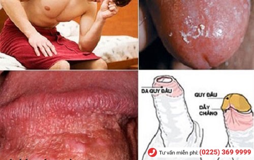 Hình ảnh nấm bao quy đầu Hình ảnh nấm bao quy đầu