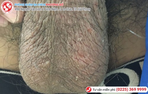 hình ảnh nấm tinh hoàn