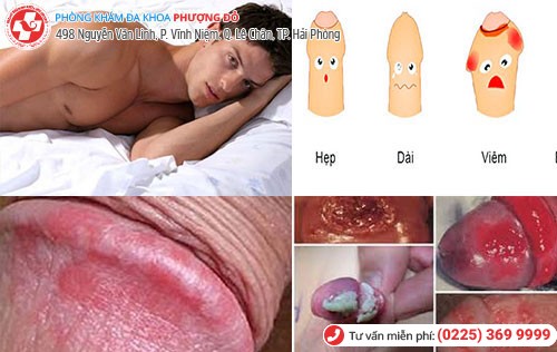 Ngứa bao quy đầu do nhiều bệnh gây nên Ngứa bao quy đầu do nhiều bệnh gây nên