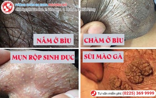 Ngứa bìu tinh hoàn là dấu hiệu nhiều bệnh nguy hiểm Ngứa bìu tinh hoàn là dấu hiệu nhiều bệnh nguy hiểm
