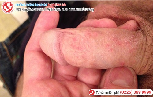 Ngứa đầu dương vật do nhiều nguyên nhân gây nên Ngứa đầu dương vật do nhiều nguyên nhân gây nên