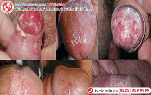 ngứa bao quy đầu