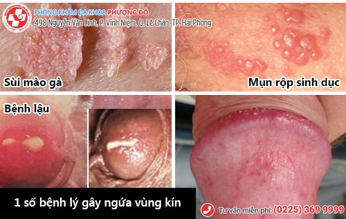 ngứa bộ phận sinh dục nam
