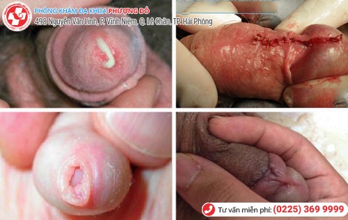 Nguyên nhân đau dương vật ở nam Nguyên nhân đau dương vật