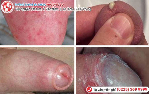 Nguyên nhân hôi dương vật ở nam Nguyên nhân hôi dương vật ở nam