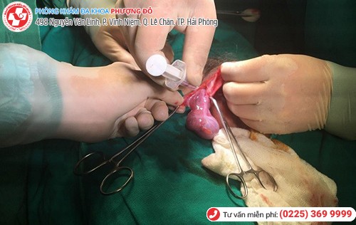 Phẫu thuật tháo xoắn tinh hoàn được thực hiện tại Phượng Đỏ Phẫu thuật tháo xoắn tinh hoàn được thực hiện tại Phượng Đỏ