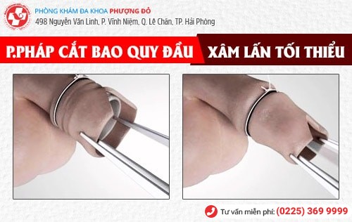 Địa chỉ cắt bao quy đầu uy tín ở Hải Phòng Địa chỉ cắt bao quy đầu uy tín ở Hải Phòng