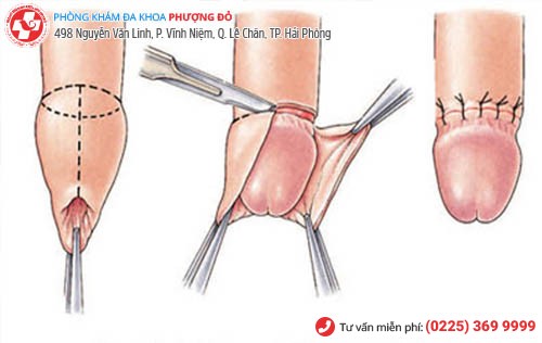 Cắt bao quy đầu