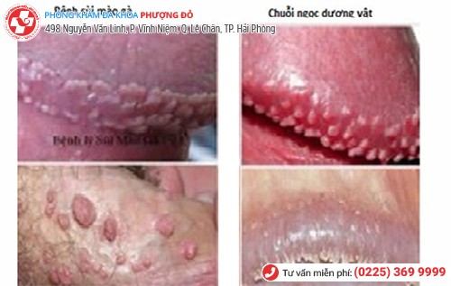 nổi mụn bao quy đầu