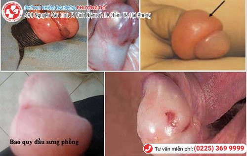 sưng bao quy đầu