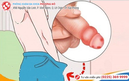 dương vật sưng như cục mỡ