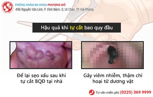 Súyt mất của quý vì tự cắt bao quy đầu tại nhà Súyt mất của quý vì tự cắt bao quy đầu tại nhà