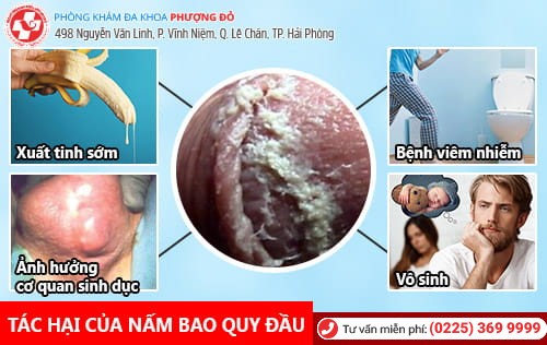 Nấm bao quy đầu – Khốn khổ vì ngứa rát mọi nơi mọi lúc Nấm bao quy đầu – Khốn khổ vì ngứa rát mọi nơi mọi lúc