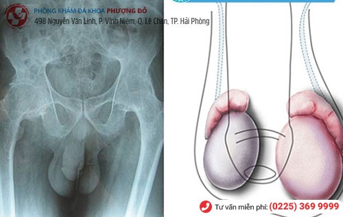 Hình ảnh tinh hoàn không đều Hình ảnh tinh hoàn không đều