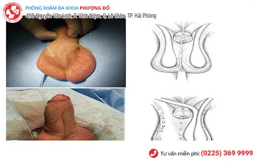 tinh hoàn lúc to lúc nhỏ