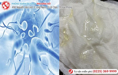 Hình ảnh tinh trùng đặc vón cục Hình ảnh tinh trùng đặc vón cục