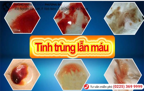 Tinh trùng lẫn máu do nhiều nguyên nhân khác nhau gây nên Tinh trùng lẫn máu do nhiều nguyên nhân khác nhau gây nên