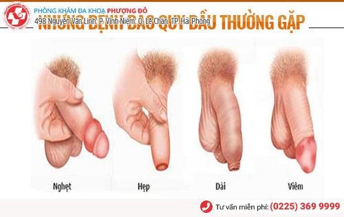 Tổng quan bệnh bao quy đầu Tổng quan bệnh bao quy đầu