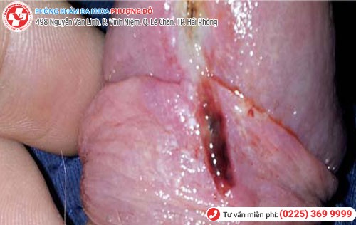 Trầy xước bao quy đầu 2 Trầy xước bao quy đầu 2