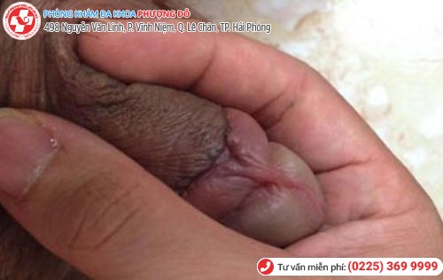 Trầy xước bao quy đầu 3 Trầy xước bao quy đầu 3