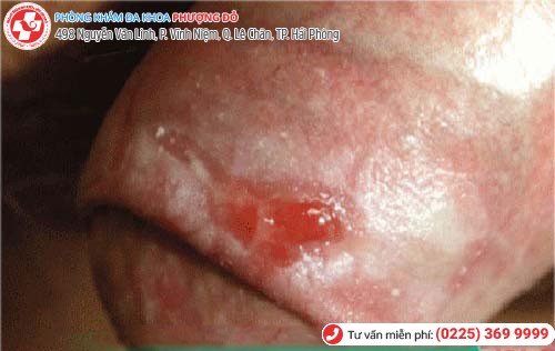 Trầy xước bao quy đầu 4 Trầy xước bao quy đầu 4