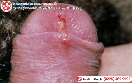 Trầy xước bao quy đầu 5 Trầy xước bao quy đầu 5