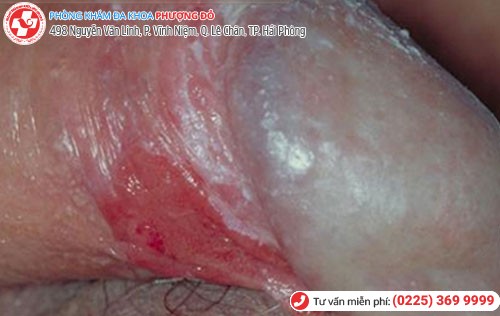 Trầy xước bao quy đầu 6 Trầy xước bao quy đầu 6