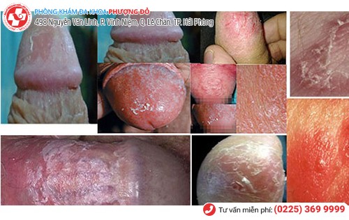 tróc da dương vật