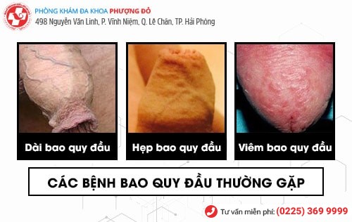 phòng khám cắt bao quy đầu phòng khám cắt bao quy đầu
