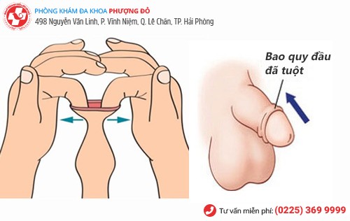Tuột bao quy đầu Tuột bao quy đầu
